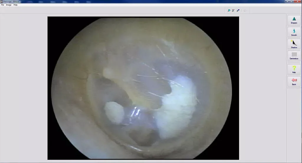 video-otoscopy.webp